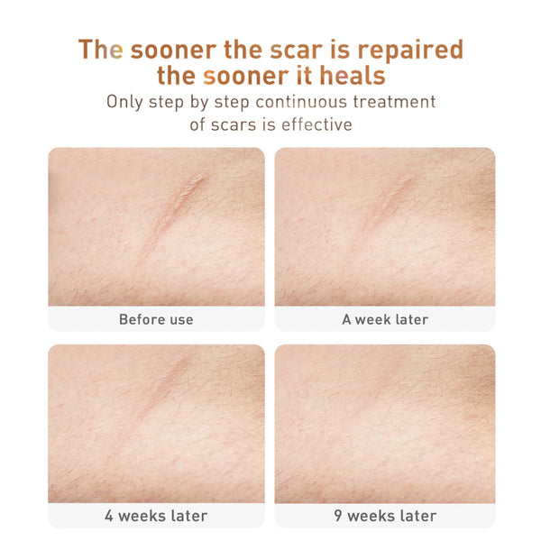 Scar Removal Cream